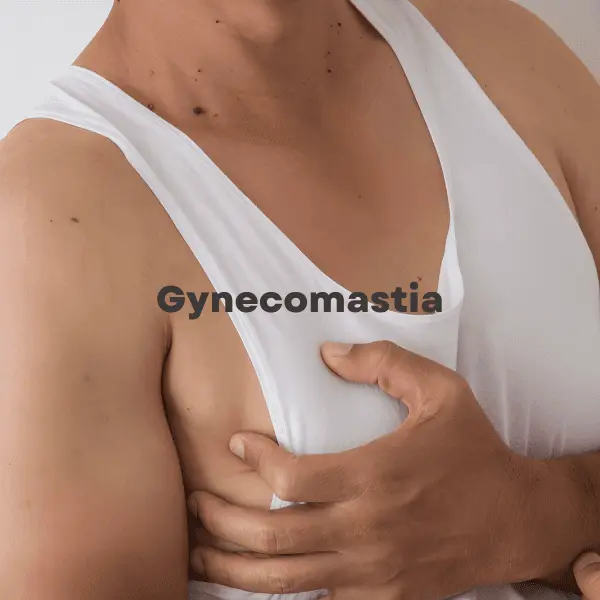 Gynecomastia — detail