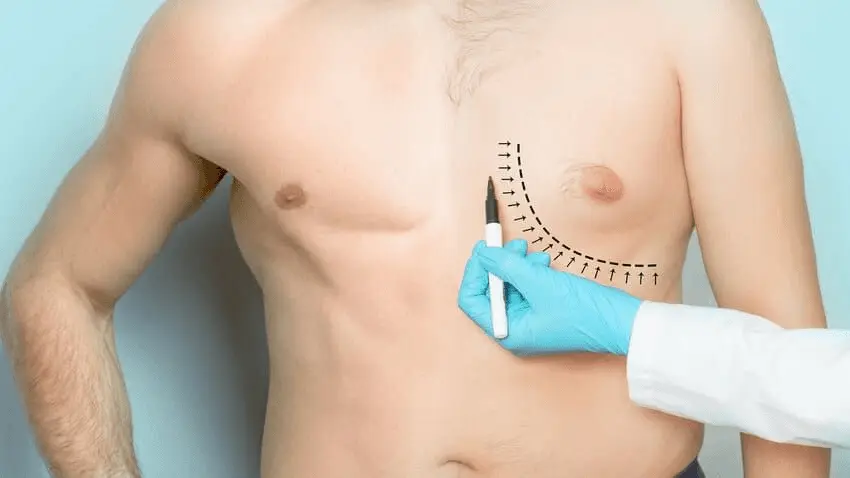 Gynecomastia